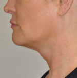 FaceTite Before and After Photos