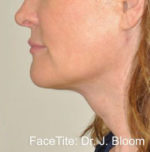 FaceTite Before and After Photos