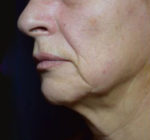 FaceTite Before and After Photos