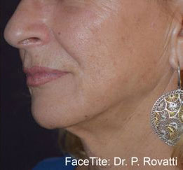FaceTite Case 399 After Photo FaceTite