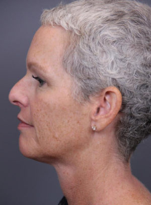 Intense Pulsed Light Before & After