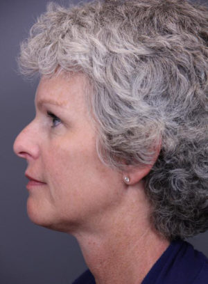 Intense Pulsed Light Before & After