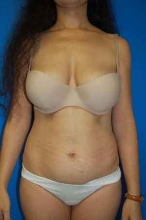 Abdominoplasty or Tummy Tuck Case 48 Before Photo Abdominoplasty or Tummy Tuck