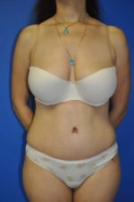 Abdominoplasty or Tummy Tuck