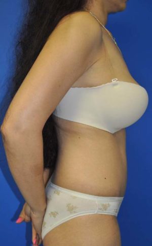 Abdominoplasty or Tummy Tuck Case 48 After Photo Abdominoplasty or Tummy Tuck