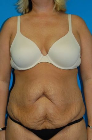 Abdominoplasty or Tummy Tuck