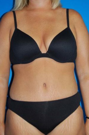 Abdominoplasty or Tummy Tuck Case 49 After Photo Abdominoplasty or Tummy Tuck