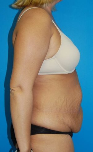 Abdominoplasty or Tummy Tuck