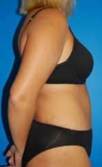 Abdominoplasty or Tummy Tuck