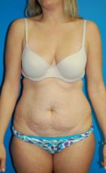 Abdominoplasty or Tummy Tuck