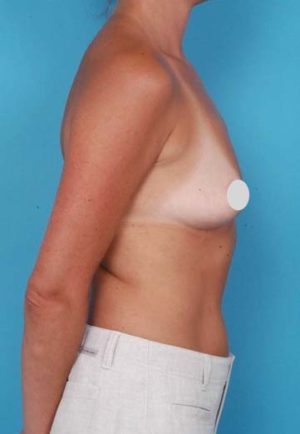Breast Augmentation Case 61 Before Photo Breast Augmentation