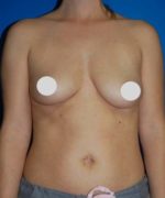 Breast Augmentation Before and After Photos
