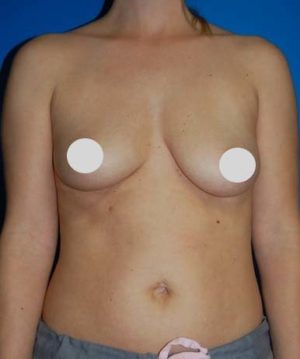 Breast Augmentation Before and After Photos
