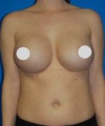 Breast Augmentation Before and After Photos