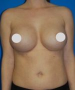 Breast Augmentation