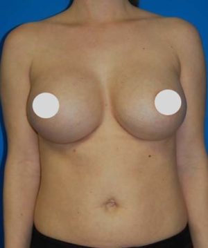 Breast Augmentation Before and After Photos