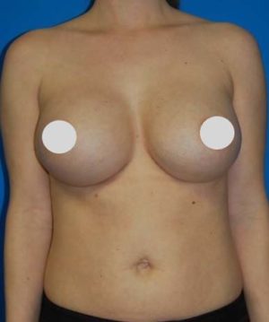 Breast Augmentation