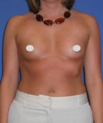 Breast Augmentation Before and After Photos