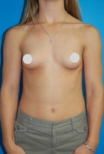 Breast Augmentation Before and After Photos