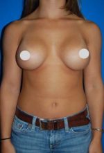 Breast Augmentation Before and After Photos