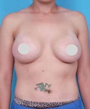 Breast Augmentation Before and After Photos