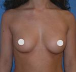 Breast Augmentation Before and After Photos