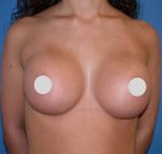 Breast Augmentation Before and After Photos