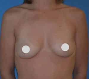 Breast Augmentation Before and After Photos