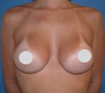 Breast Augmentation Before and After Photos