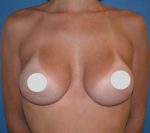 Breast Augmentation