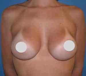 Breast Augmentation Before and After Photos