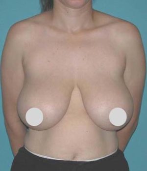 Breast Reduction and Breast Lift