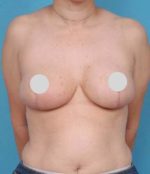 Breast Reduction and Breast Lift