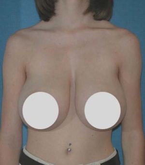 Breast Reduction and Breast Lift