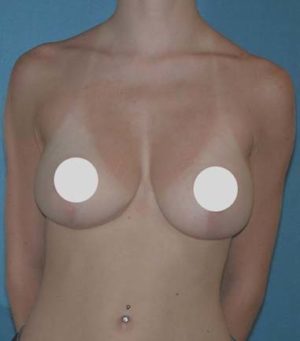 Breast Reduction and Breast Lift