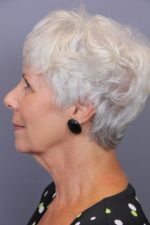 Timeless Lift & 1540 Skin Revitalization Before & After