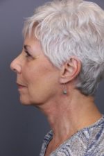 Timeless Lift & 1540 Skin Revitalization Before & After