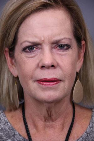 Facial Rejuvenation Before and After Photos Case 97 Before Photo Facial Rejuvenation Before and After Photos