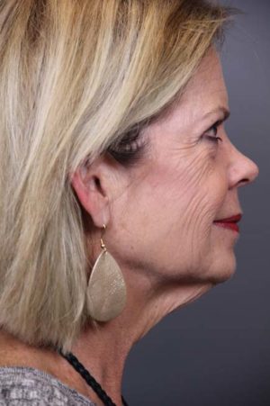 Facial Rejuvenation Before and After Photos Case 97 Before Photo Facial Rejuvenation Before and After Photos