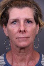 Facial Rejuvenation Before and After Photos