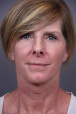 Facial Rejuvenation Before and After Photos