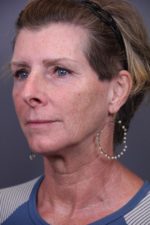 Facial Rejuvenation Before and After Photos