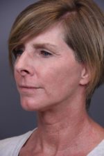 Facial Rejuvenation Before and After Photos