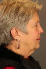 Facial Rejuvenation Before and After Photos