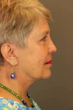 Facial Rejuvenation Before and After Photos