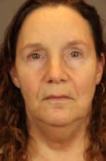 Facial Rejuvenation Before and After Photos