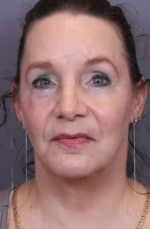 Facial Rejuvenation Before and After Photos