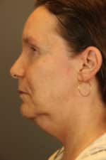 Facial Rejuvenation Before and After Photos