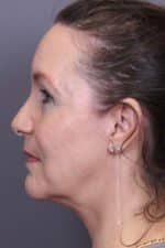 Facial Rejuvenation Before and After Photos