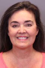 Facial Rejuvenation Before and After Photos